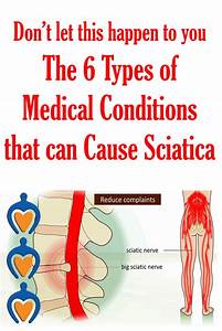 Pin On About Sciatica Treatment