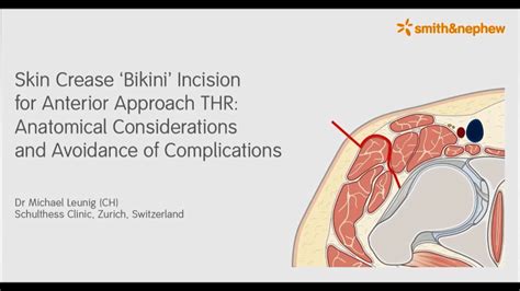 ‘bikini Incision For Direct Anterior Approach Total Hip Arthroplasty