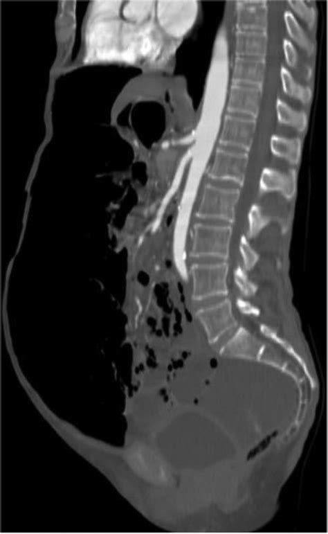 Abdominal Tomography Scan With Sagittal Reconstruction Showing Abundant