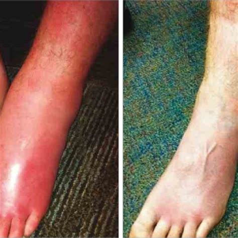 Pdf Bilateral Lower Extremity Inflammatory Lymphedema In Air Force
