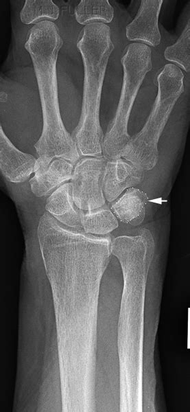 Carpal Bone Fractures Wikiradiography