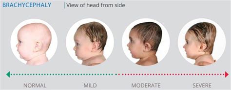 Brachycephaly Treatment And Results Atelier Yuwaciaojp