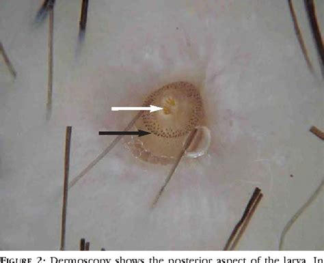 Figure 2 From Dermoscopy Features For The Diagnosis Of Furuncular Myiasis Semantic Scholar
