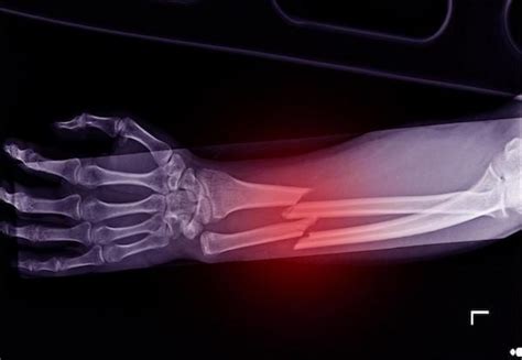 How To Know If Your Bone Is Broken Paris Orthopedics