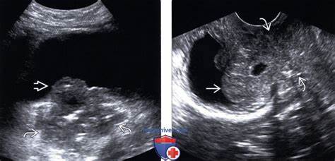 Диета рак шейки матки Рак шейки матки 1 стадия фото Рак шейки матки 1 стадия фото Диета рак шейки матки