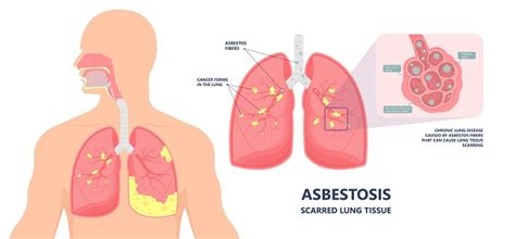 Asbestosis Patofisiologi Diagnosis Penatalaksanaan Alomedika