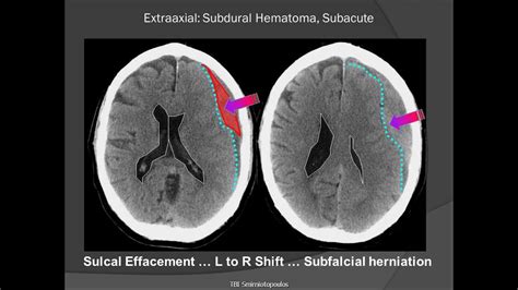 Epidural hematoma, subdural hematoma, subarachnoid hematoma, intracerebral hemorrhage. Subdural Hematoma (SDH) - YouTube