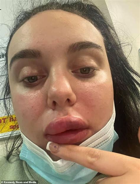Dental Nurse 21 Claims She Almost Went Blind And Lost Her Lip After