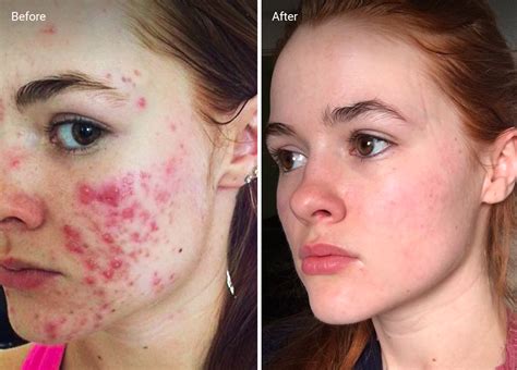 Accutane For Acne How To Use It Safety Side Effects And More