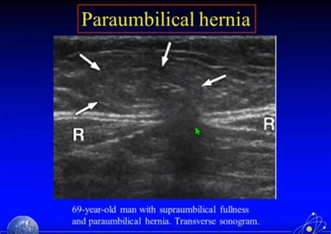 Finally We Have An Incisional Hernia