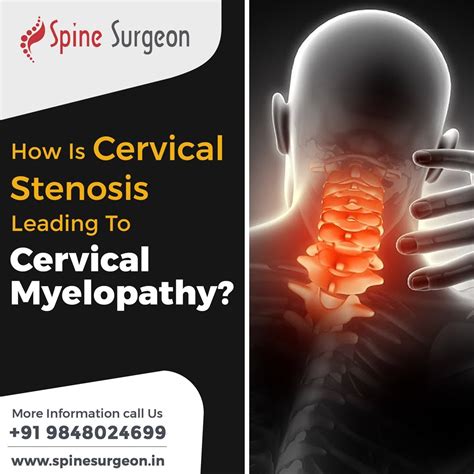 How Is Cervical Stenosis Leading To Cervical Myelopathy Spine Surgeon