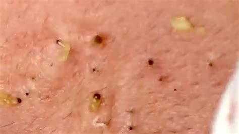 Pimple Popping 2020 Hot Blackheads Extraction Blackheads Removal