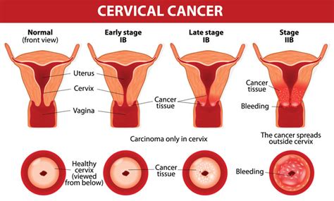 Cervical Cancer Screening Stages And Symptoms Gleneagles Hospital