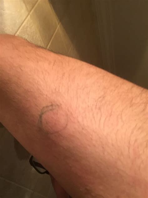 I Have A 4 5cm Lump On Upper Arm Bicep Is It Really A Cyst Ask A