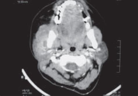 Axial Contrast Enhanced Ct Shows Enlarged Right Parotid Gland With A