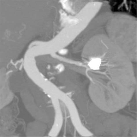 Abdominal Contrast Enhanced Computed Tomography 1 Month After The