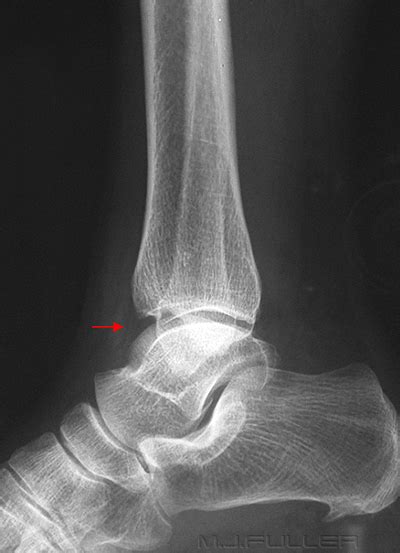 Medial And Lateral Malleolus