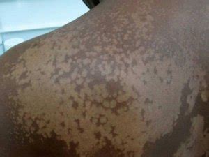 Malassezia fungi are specialized to live on skin and associated with dandruff, eczema. Pityriasis alba witte ronde vlekken op gezicht en lichaam