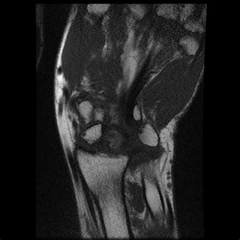 Scaphoid Proximal Pole And Lunate Avascular Necrosis Image