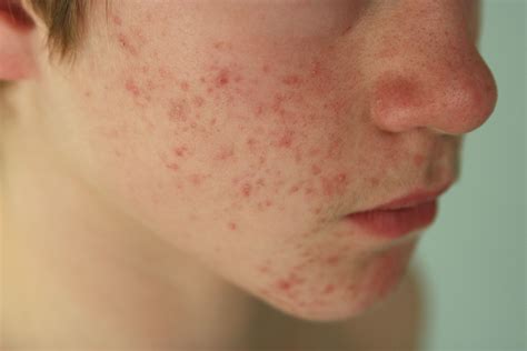 It's actually not an acne at all. What Is Rosacea? - Definition in Acne