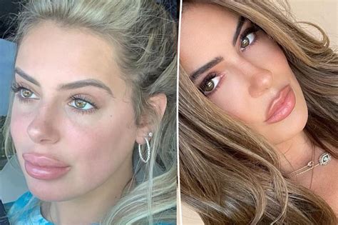 brielle biermann warns against getting lips ‘overfilled with shocking before and after photos