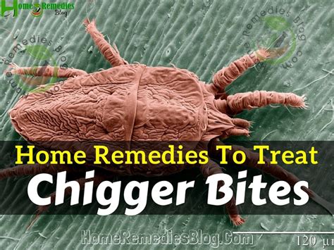 15 Best Home Remedies To Treat Chigger Bites Home Remedies Blog