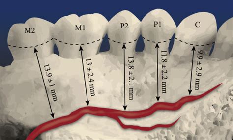 What Is The Safety Zone For Palatal Soft Tissue Graft Harvesting Based