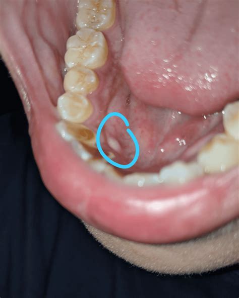 White Spots In Mouth