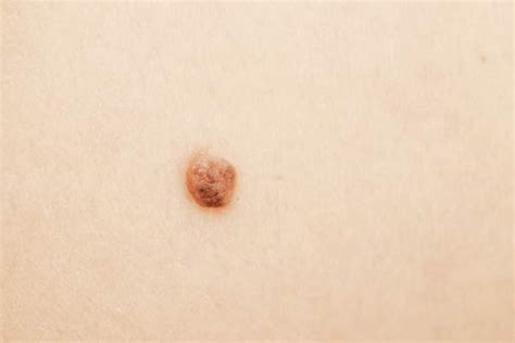 Skin Cancer Black Mole