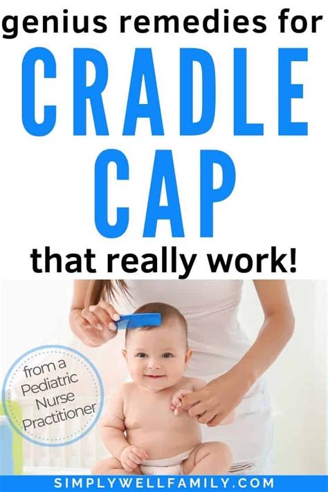 Cradle Cap What Is It And How To Treat It Cradle Cap Cradle Cap