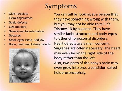 Ppt Trisomy 13 Powerpoint Presentation Free Download Id 668954