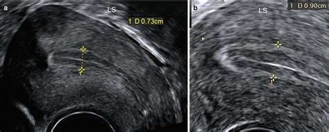 Ultrasound Evaluation Of Endometrium Obgyn Key