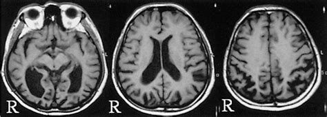 Figure From White Matter Loss In The Splenium Of The Corpus Callosum