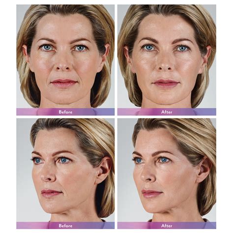 Facial Filler Before And After Feel Ideal Med Spa Southlake TX