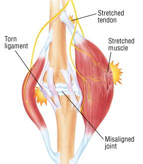 It is formed by basic types of peroneal tendon injuries are tendinitis, acute and degenerative tears, and subluxation. Muscle strain treatment. Causes, symptoms, treatment ...
