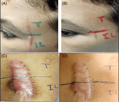 Hypertrophic Scars A Before Treatment B Six Months After Four Download Scientific Diagram