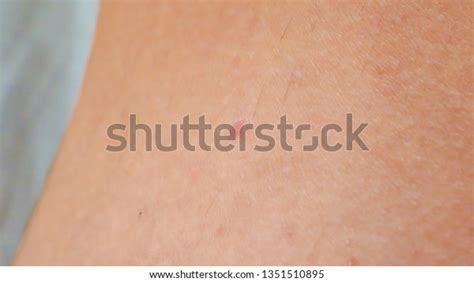 Red Spot On Skin Few Hair Stock Photo 1351510895 Shutterstock