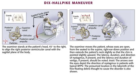 Dix Hallpike Maneuver For Bppv Procedure 1 Make Grepmed