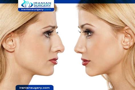 Bad Rhinoplasty Bad Nose Jobs Before And After Nose Job Gone Wrong