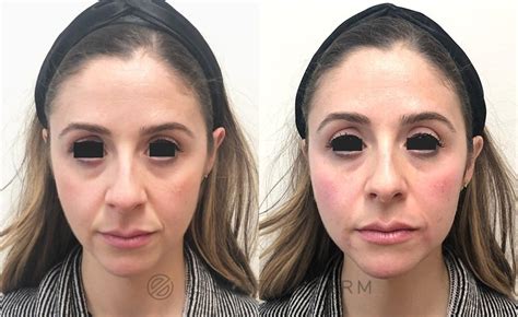 Dermal Fillers Before And After Pictures Case 9 Natick Ma Essential Dermatology