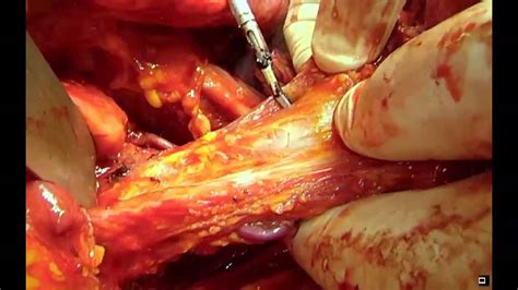 She lost the battle on march 4th 2012 and i miss her so much. FIGO 2012: LIVE SURGERY Advanced Ovarian Cancer Part.3 ...