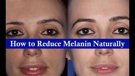 How To Reduce Melanin In Skin Naturally How To Reduce Melanin In Face Get Fair Skin Youtube