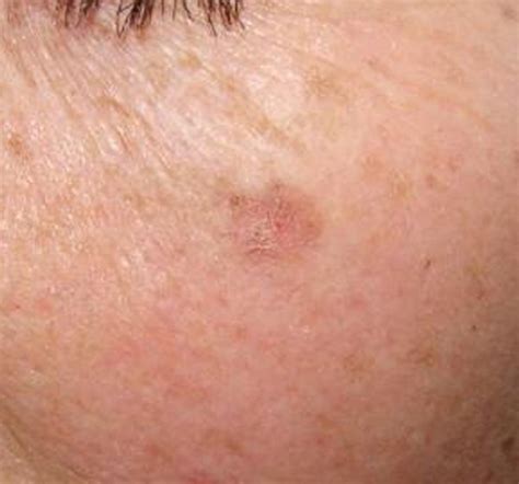 Actinic Keratosis The Most Common Precancerous Skin Lesion Skin My