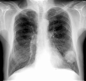LUNG CANCER 2 - Buyxraysonline Lung Cancer  