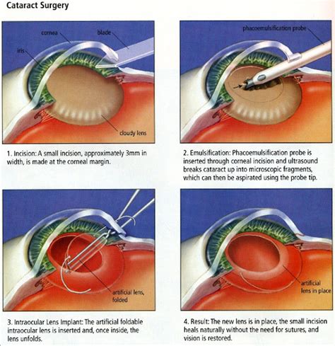 Cataract Its Causes Treatment And Cataract Surgery Eye Health Nepal