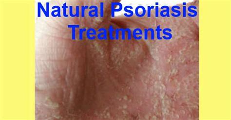 12 Natural Ways To Relieve Psoriasis