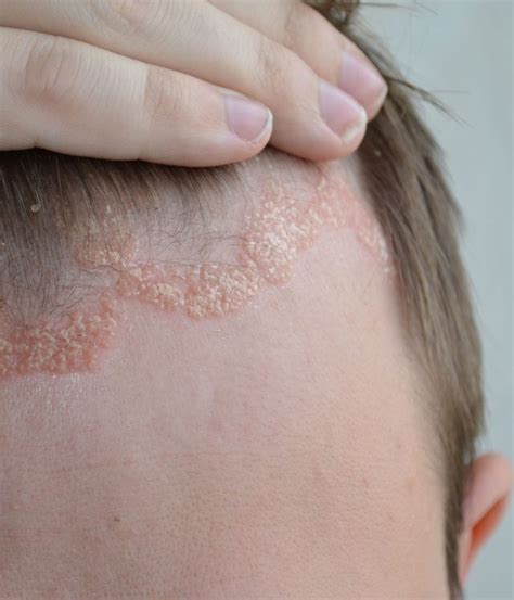 Psoriasis Treatments Mesa Az Sagebrush Dermatology