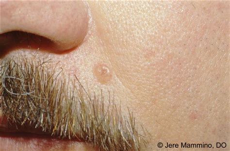 Basal Cell Carcinoma American Osteopathic College Of Dermatology Aocd