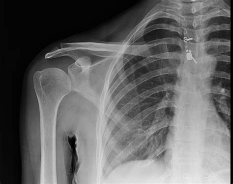 Acromioclavicular Joint X Ray Hot Sex Picture