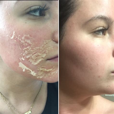 List Pictures Chemical Peels Before And After Pictures Stunning